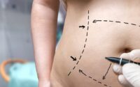 Liposuction vs Tummy Tuck: Which Is the Better Fat Reduction Solution
