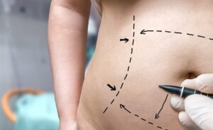 Liposuction vs Tummy Tuck: Which Is the Better Fat Reduction Solution